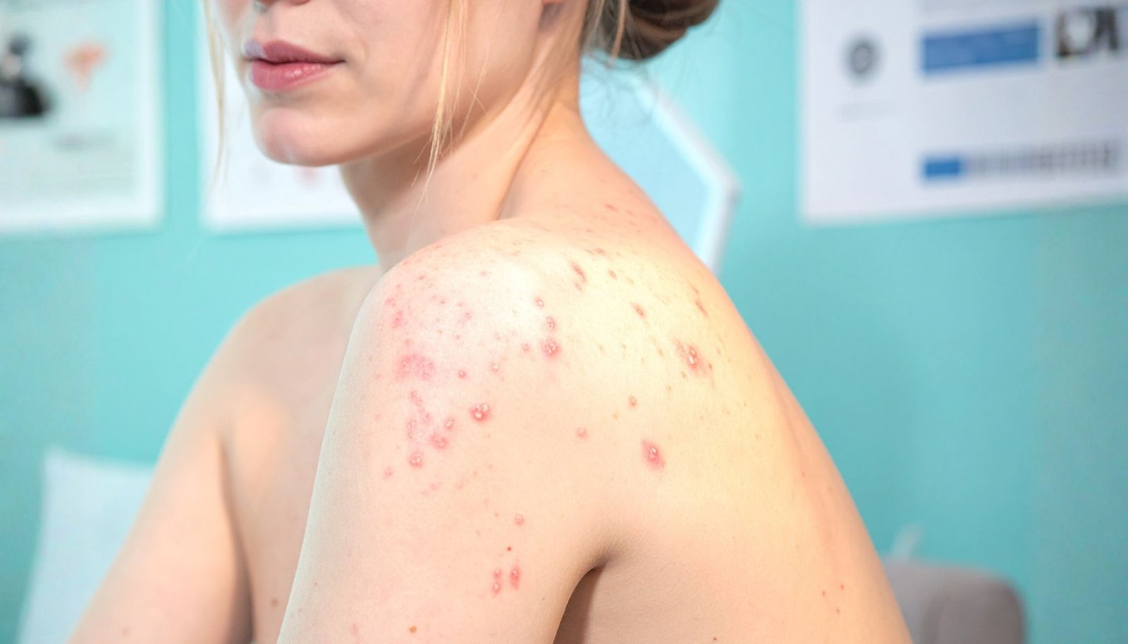 Benarkah Jerawat Punggung Hanya Masalah Kebersihan?