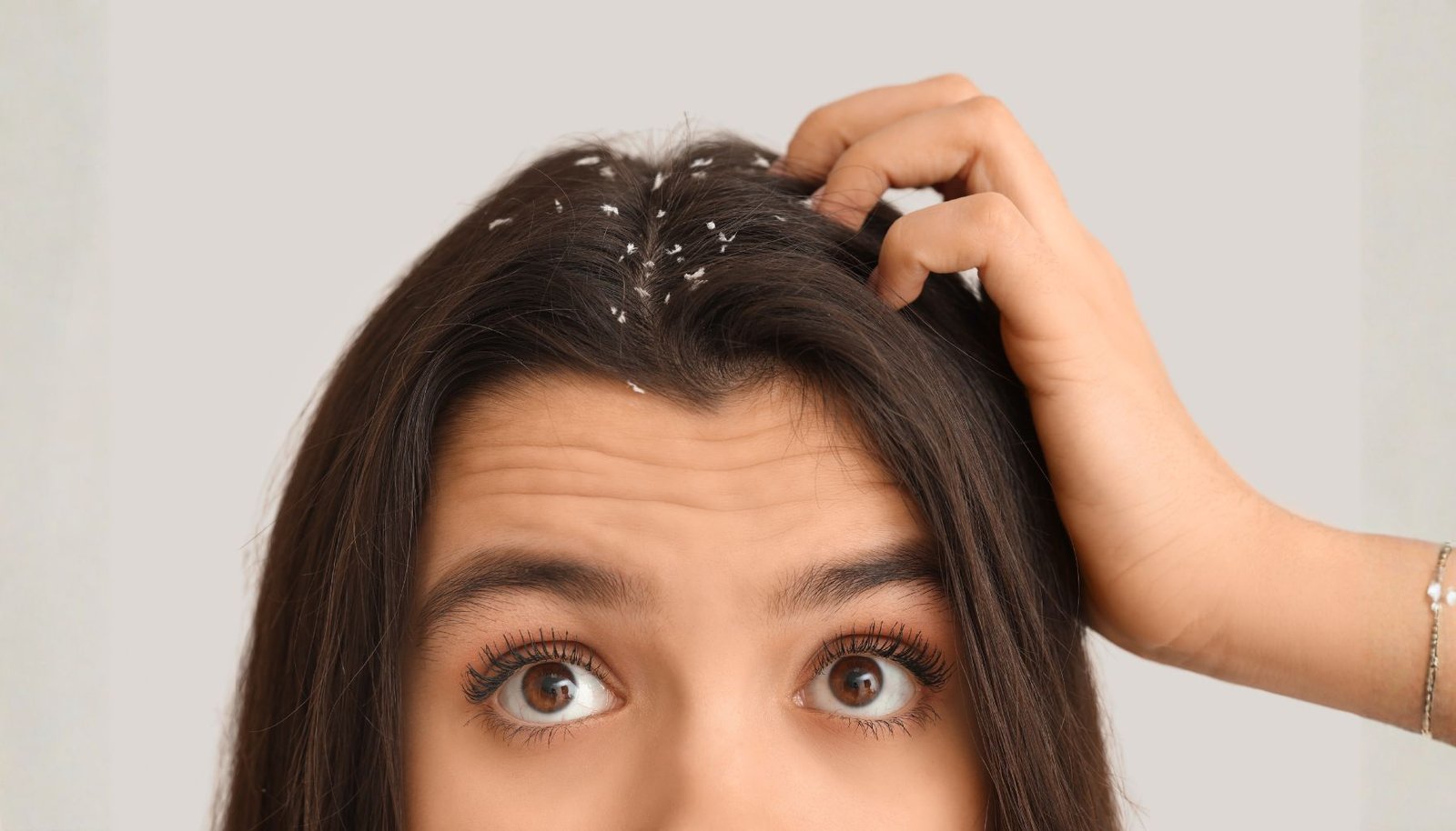 Kenapa Ketombe Tak Pernah Benar-Benar Hilang?